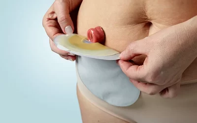The Benefits of Ostomy Care