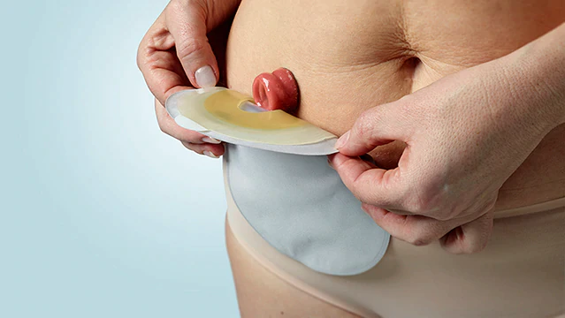 The Benefits of Ostomy Care